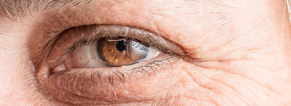 Foto blefaroplastia